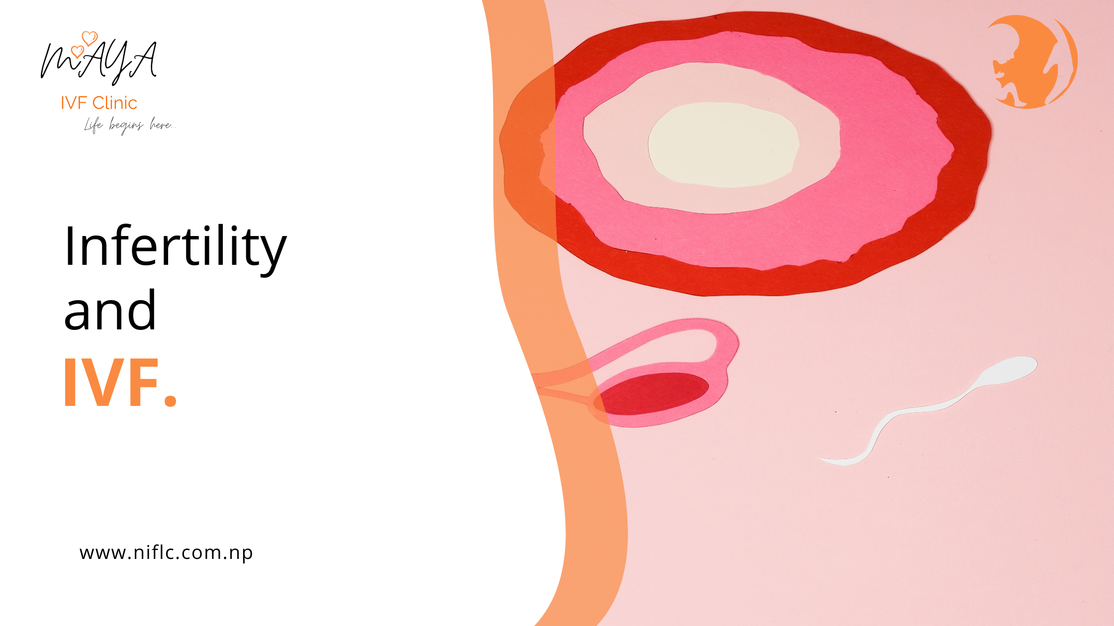 IVF procedure for infertility