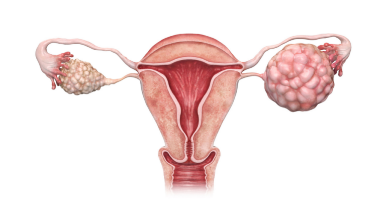 PCOS and its impact on fertility
