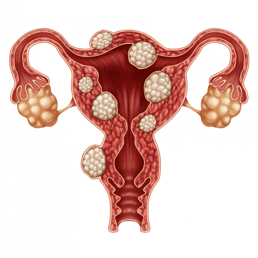 Illustration showing uterine fibroids
